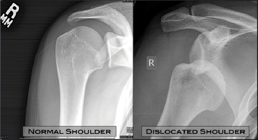 What is traumatic anterior shoulder dislocation?