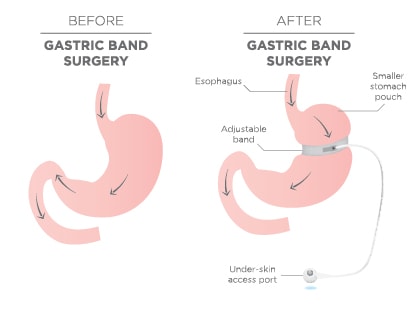 Gastric band surgery