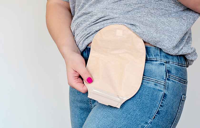 Woman with stoma or colostomy bag
