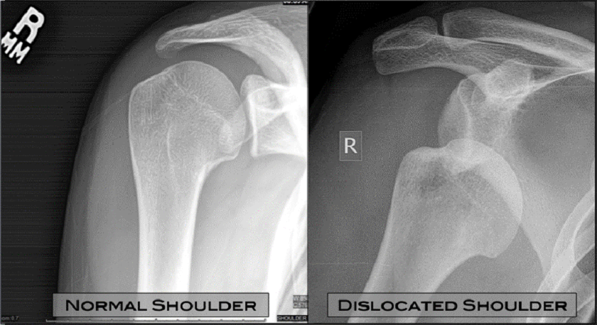 St John of God Mt Lawley Hospital shoulder dislocation