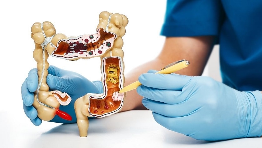 health professional holding a model of a colon.