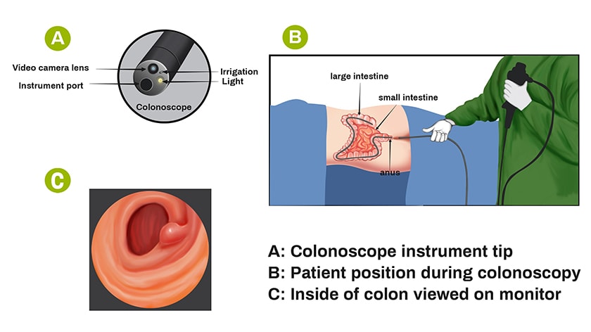 colonoscopy diagram