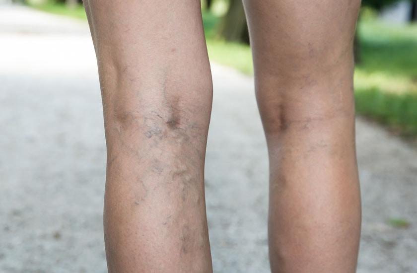 Varicose veins