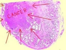 Prostate biopsy